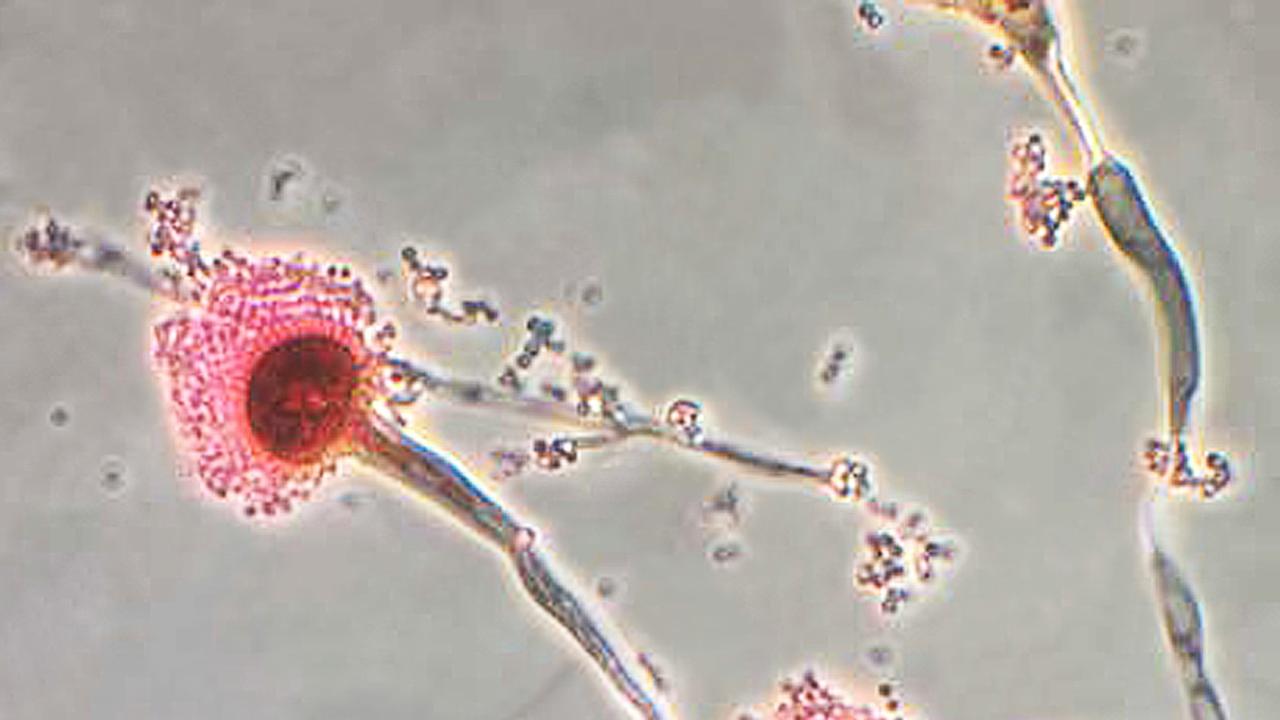 Killer Superbug Outbreak: Urgent Health Alert